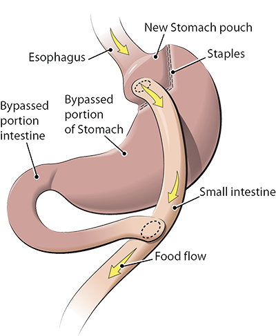 gastric bypass diagram